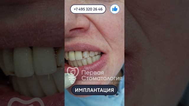 Имплантация зубов пациенту. Особый случай.