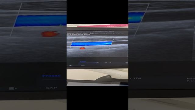 Врачебная ошибка. Узи сосудов. Сосудистый хирург. Флеболог Москва смотреть онлайн