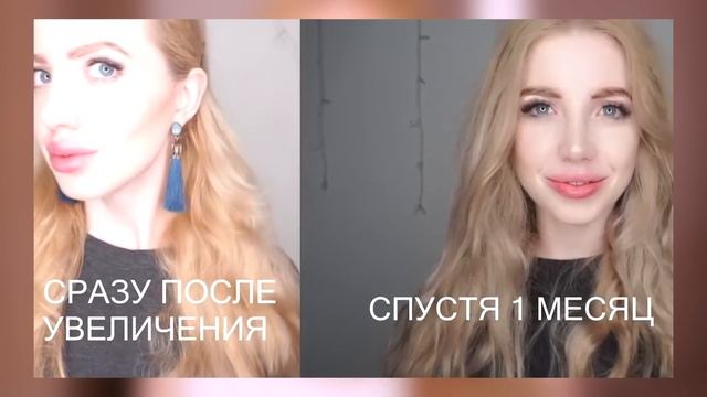 НЕ КОЛИТЕ ГУБЫ!!! ПОСЛЕДСТВИЯ УВЕЛИЧЕНИЯ ГУБ СПУСТЯ 6 ЛЕТ