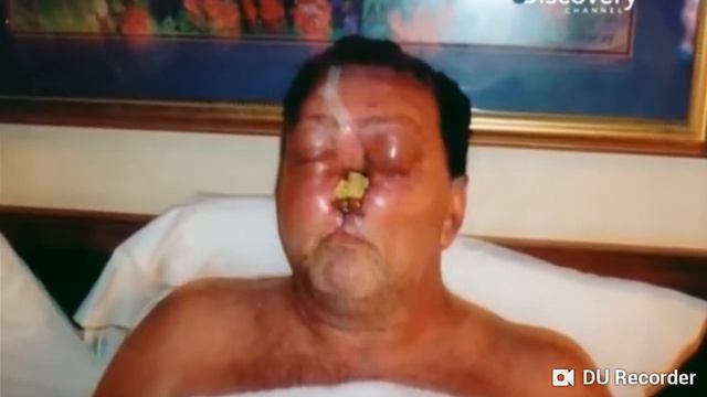 Человек от рака потерял нос смотрите что сделал рак сним смотреть онлайн
