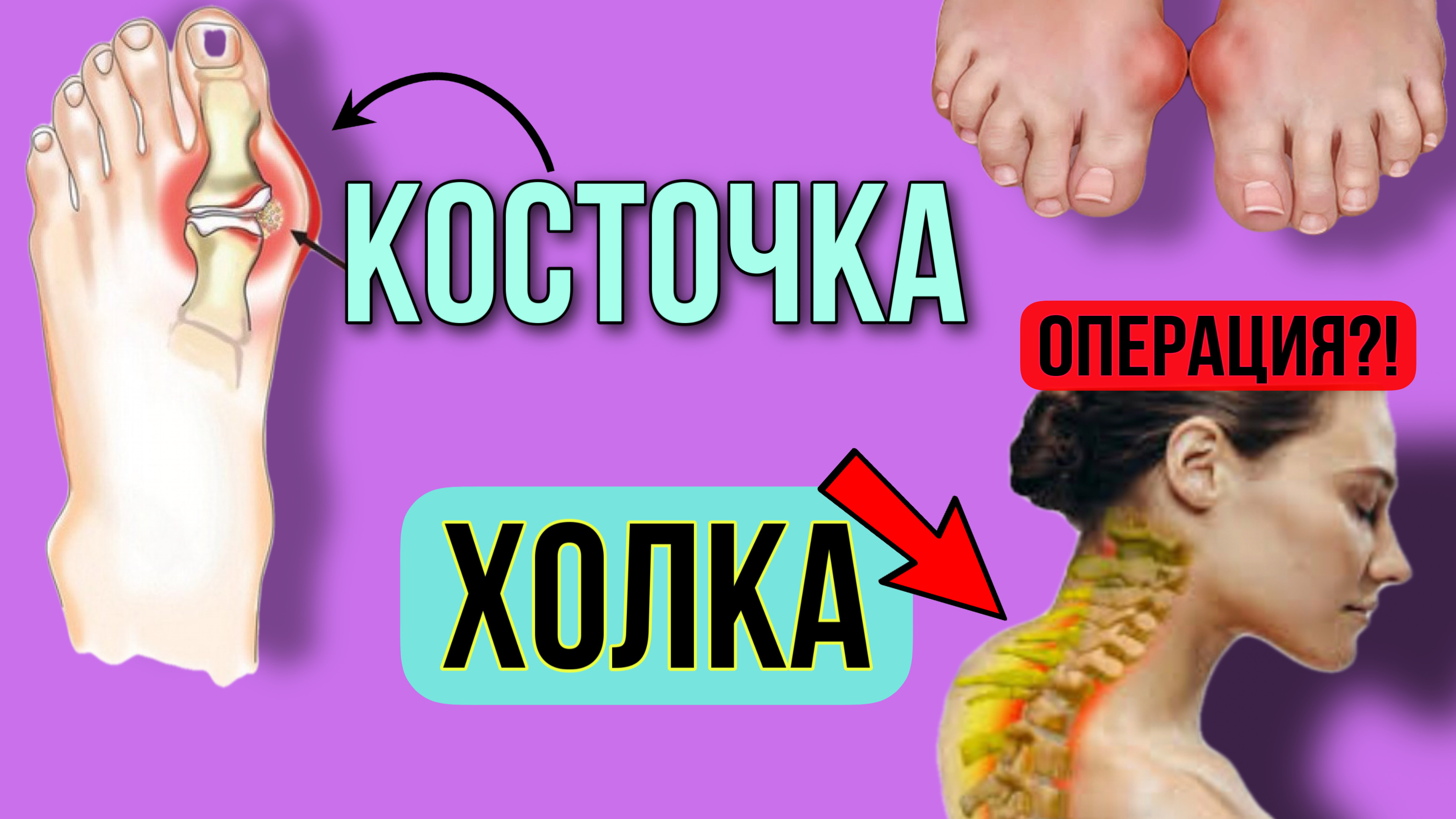 Холка - ВДОВИЙ ГОРБИК. Как избавиться? Косточка пальца ноги - халюс вальгус. Лечение без операции. смотреть онлайн