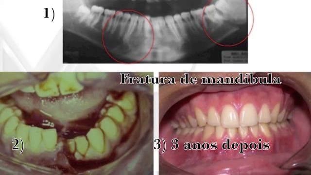 Protetor De Boca II, Dentista Barra Da Tijuca