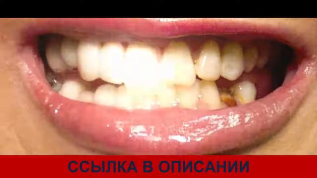 как поставить виниры snap on smile отзывы сколько стоят виниры смотреть онлайн