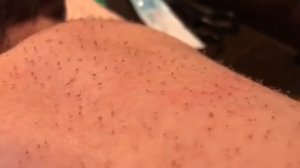 Щетинка у новорожденного ребенка.