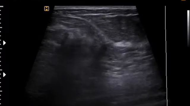 Малигнизация кисты молочной железы на ACCUVIX-XG(13-7-17) смотреть онлайн