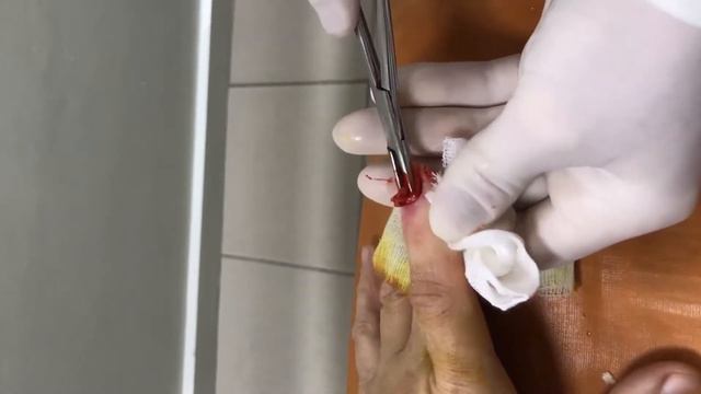 УДАЛЕНИЕ НОГТЕВОЙ ПЛАСТИНЫ смотреть онлайн