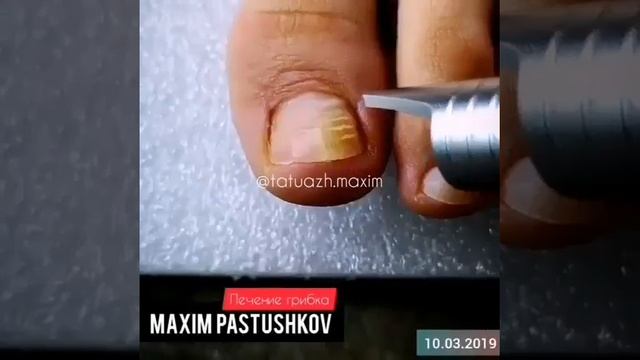 Maxim Pastushkov Удаление грибка на ногтях смотреть онлайн