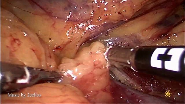 Lap nephrectomy & RPLND/retroperitoneal lymph node dissection/Лап нефрэктомия с лимфодиссекцией смотреть онлайн