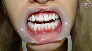 Эффективное отбеливание Д А Воробьев