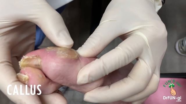 NAIL CUTTING AND CALLUS REMOVAL ON MANGLED TOES смотреть онлайн