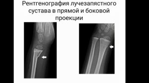 Поднадкостничный перелом лучевой кости у детей