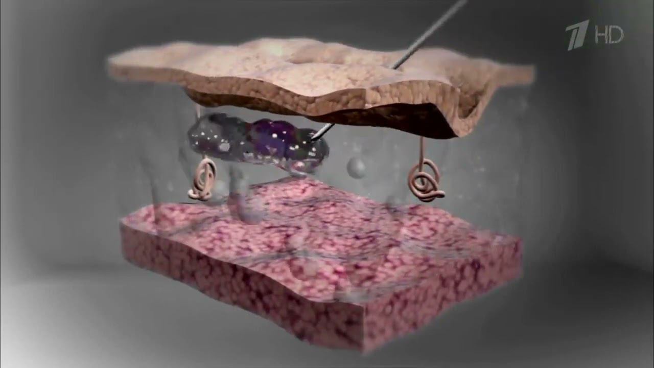 Работа филлера на основе гиалуроновой кислоты смотреть онлайн