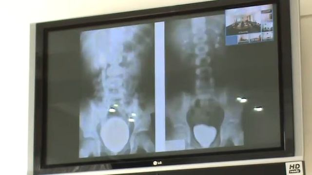 Инфекции мочевой системы у детей  Освобождение от стереотипов Ч 2