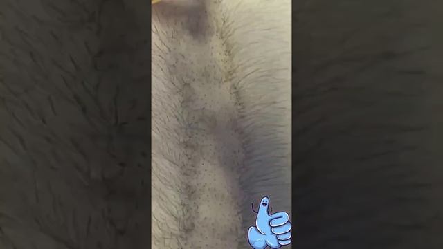 Лазерное удаление волос ?#shorts смотреть онлайн