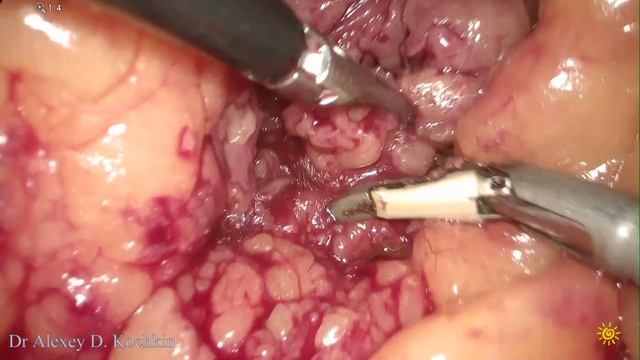 Ileal Ureter Replacement/кишечная пластика мочеточника/стриктура/ureteral Reconstruction/UPJO/ЛМС