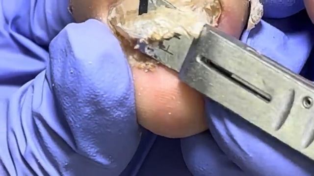 Super onychomycosis is full of black mud under it, it's horrible to see【Doctor Liu Pedicure】 смотреть онлайн