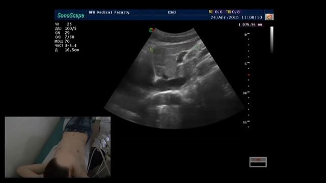 Лекция: Размеры печени (с демонстрацией на пациенте) смотреть онлайн