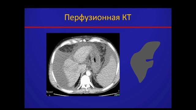 Нестеров Д.В. «Как оценить и описать очаговые изменения на фоне цирроза печени» смотреть онлайн