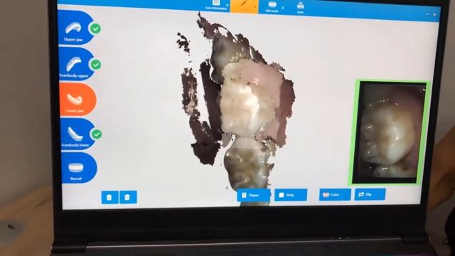 Intraoral scanning video of DL-202P смотреть онлайн