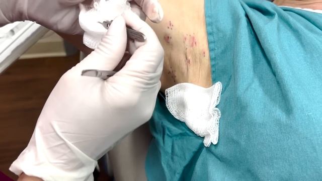 Different Shades of Butter! Dr Pimple Popper's Pops That Rearranged My Entire Life смотреть онлайн