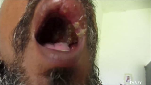 Herpes Zoster In Oral Cavity & Face смотреть онлайн