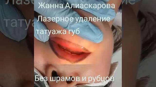 Лазерное удаление татуажа губ . Мастер Жанна Алиаскарова смотреть онлайн