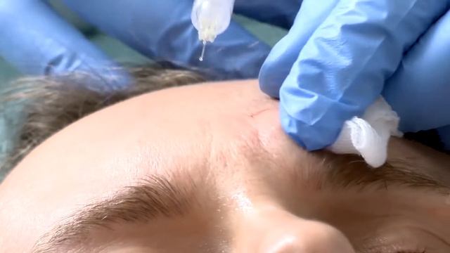 NEAUVIA Organic. Коррекция носогубных складок. Заполнение морщин межбровья. Семинар