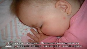 Моллюски на коже у ребенка — причины и способы лечение