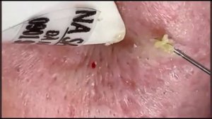 ??????? ????????? ??????? ?? ???? ????  #acne #32761 #blackheads #pimple #blackheadswhiteheads