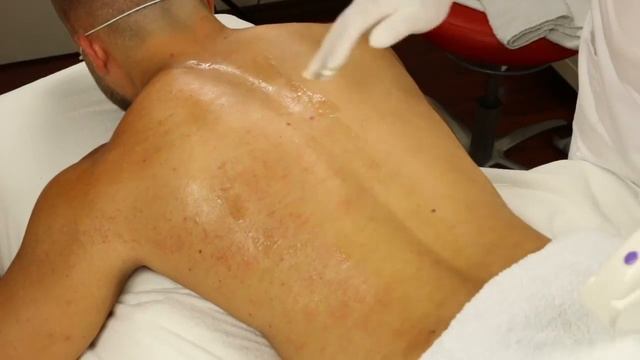 Männer Rücken | #IPL-SHR #Dauerhafte #Haarentfernung. смотреть онлайн