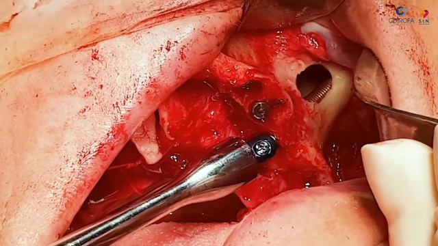 Установка скуловых имплантатов Zygomatic смотреть онлайн