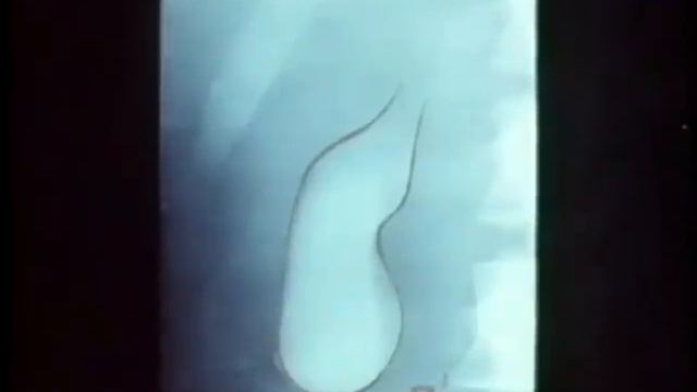 Рентген желчевыводящих путей © X-ray of bile passages смотреть онлайн
