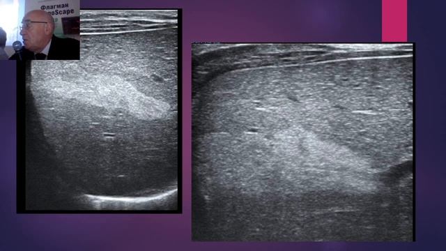Пыков Михаил Иванович «ОБЪЕМНЫЕ ПОРАЖЕНИЕ ОРГАНОВ БРЮШНОЙ ПОЛОСТИ У ДЕТЕЙ»
