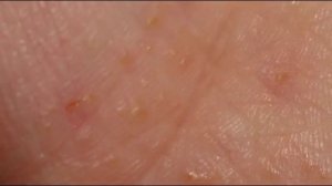 Сыпь на руках в виде прыщиков