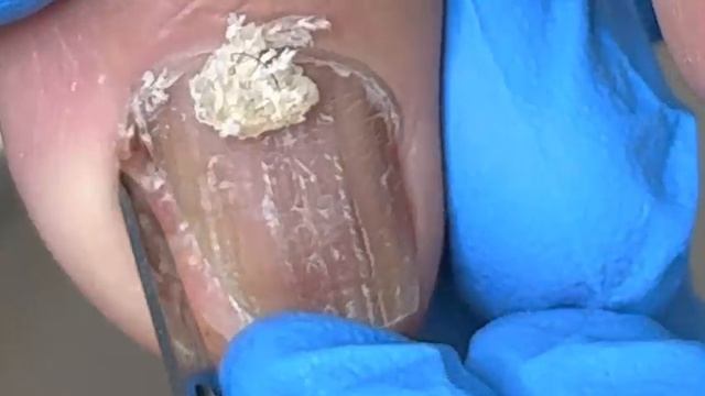 Excessive dead skin under nail fungus, clean it thoroughly【Xue Yidao】 смотреть онлайн