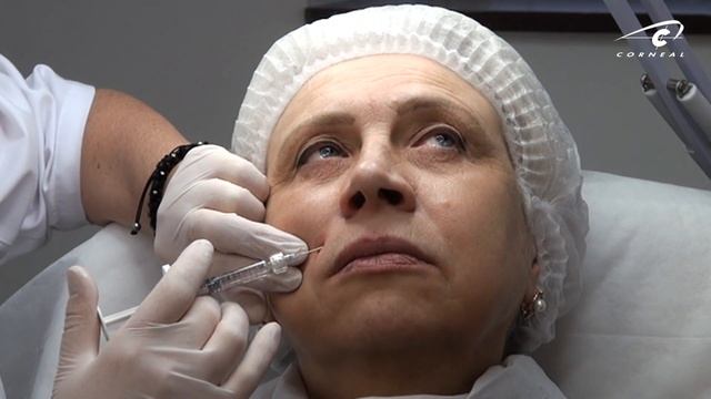 Контурная пластика обучение. Выбор техники коррекции носогубной складки. смотреть онлайн