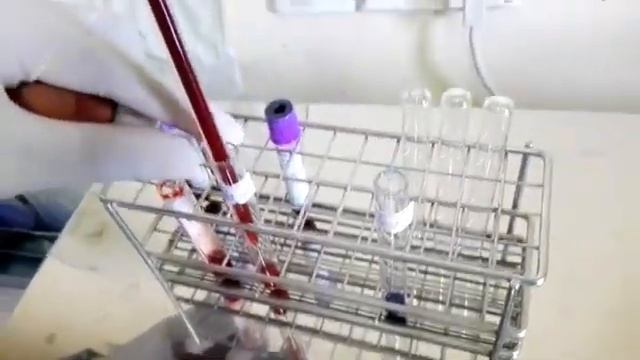 Brewers Test G6PD deficiency смотреть онлайн