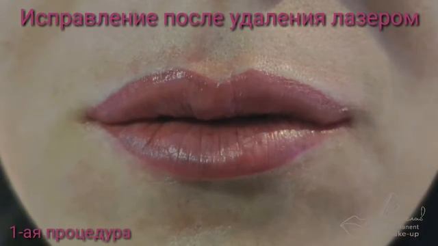 Исправление татуажа губ после удаления лазером смотреть онлайн
