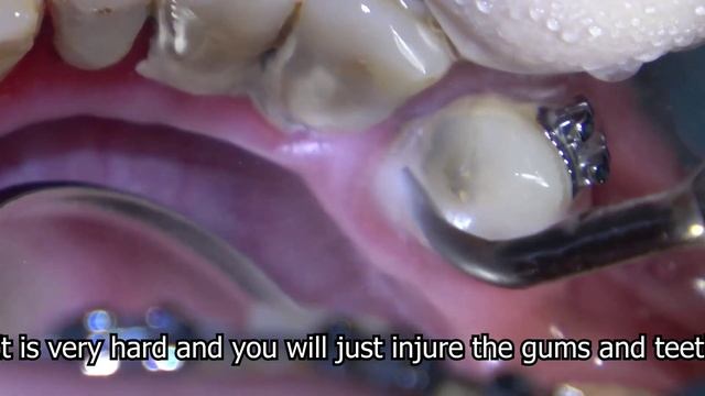 Tooth Cleaning , Ultrasonic Scaler смотреть онлайн