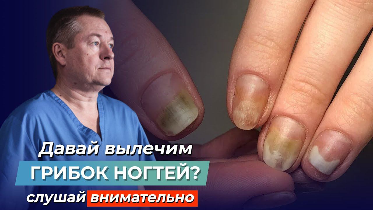 ШОКИРУЮЩАЯ ПРАВДА ПРО ГРИБОК НОГТЕЙ! Как вылечить ОНИХОМИКОЗ самостоятельно? смотреть онлайн