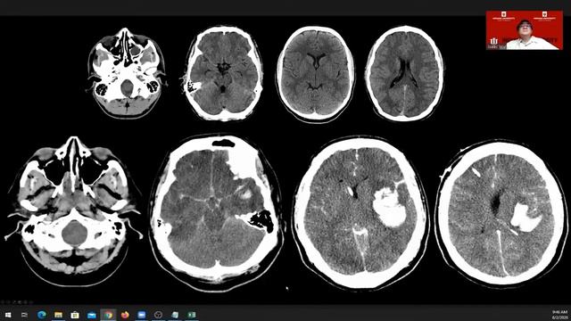 Week 4: Sunday, 2 August 2020 \ SpecialNeuro 101 \ Neuroimaging for non-neuroradiologists - Dange.. смотреть онлайн
