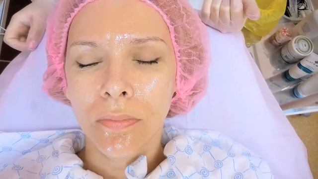 Химический миндальный пилинг лица смотреть онлайн