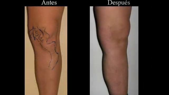 Escleroterapia. Dr. Pablo Ibáñez смотреть онлайн