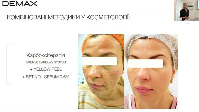 Ретинол: усі за та проти.Особливості роботи ретиноєвих пілінгів MEDICARE смотреть онлайн