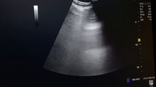 Adrenal mass with metastasis into spleen | ultrasound | DOC смотреть онлайн