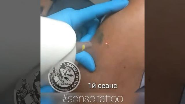 Лазерное удаление наколок и партаков в Днепре смотреть онлайн