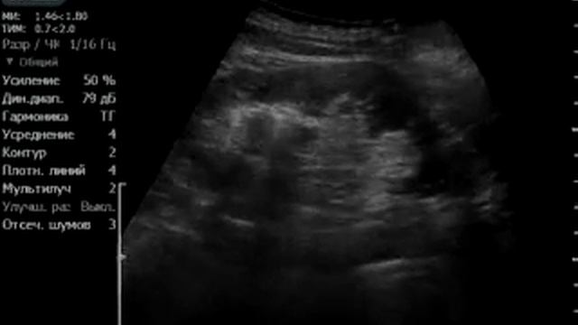 пункция кисты почки смотреть онлайн