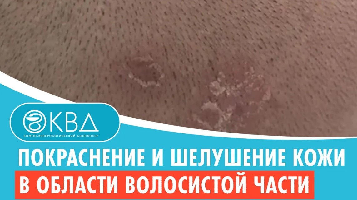 ? Покраснение и шелушение кожи в области волосистой части головы. Клинический случай №606 смотреть онлайн