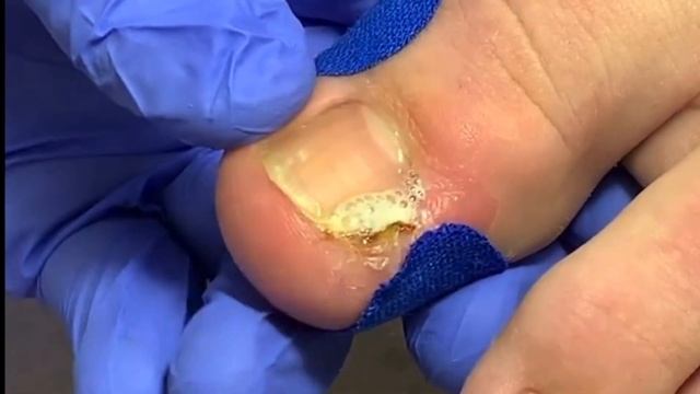 Вросший ноготь?? смотреть онлайн