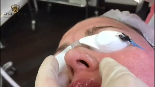 Удаление сосудистой сетки на лице: IPL смотреть онлайн